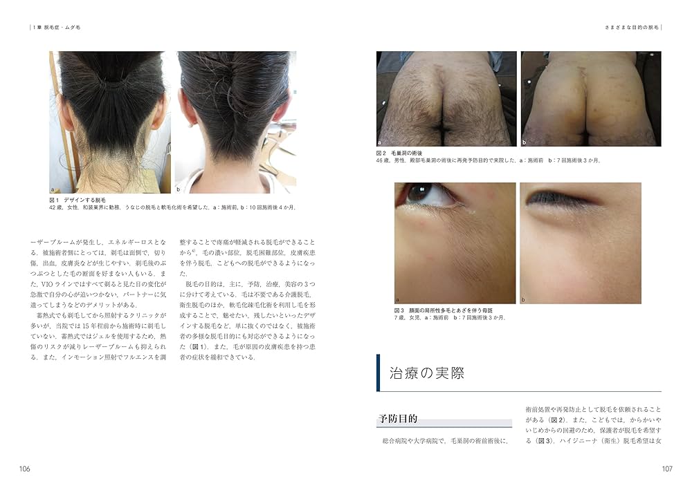 脱毛・にきびの治療 美容皮膚科オールラウンド　最新美容皮膚科学大系　5 医学書 脱毛・にきびの治療ー美容皮膚科オールラウンド (最新美容皮膚