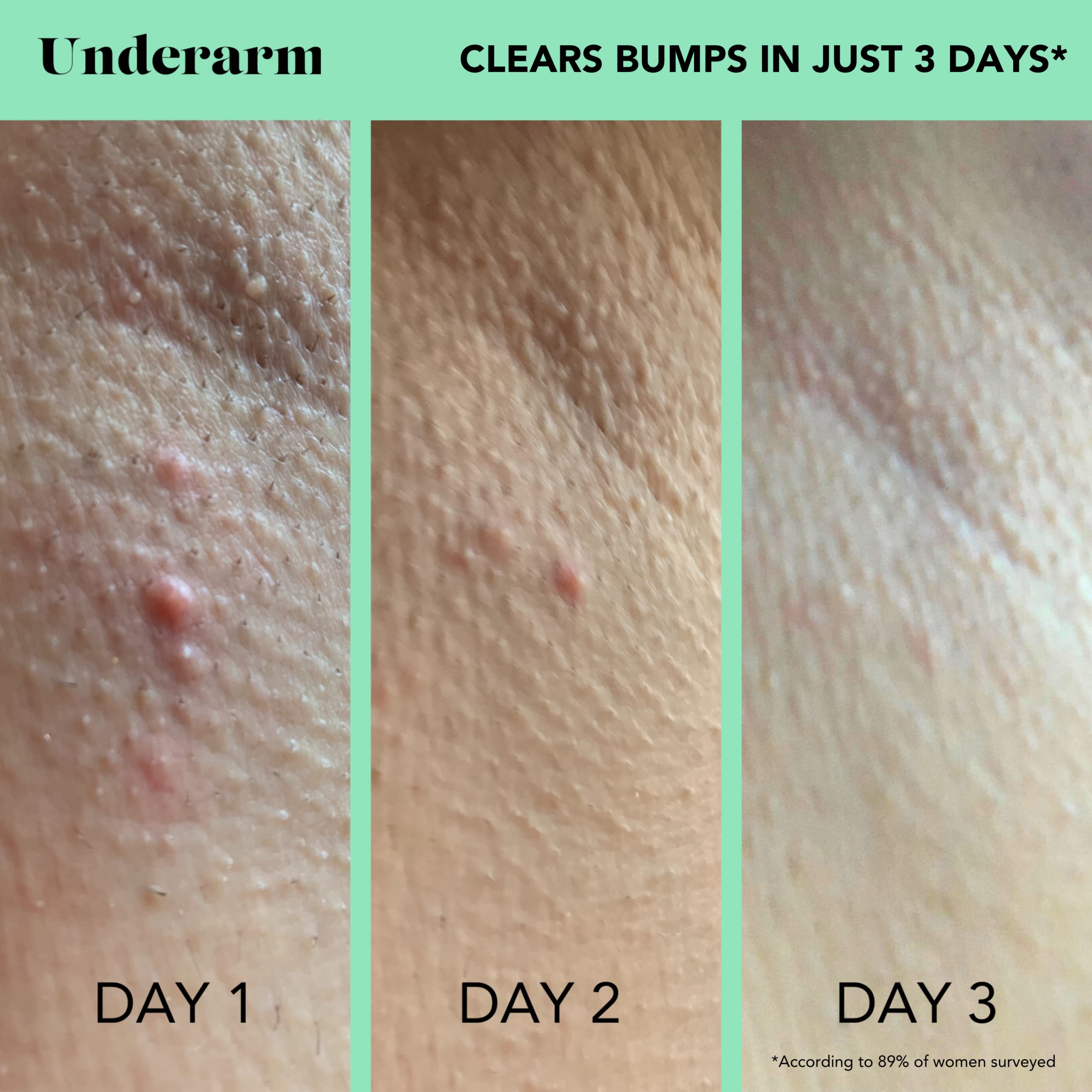 Buy Bikini & Body Bump Eraser SweetSpot Labs Salicylic Acid Spot