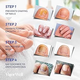 Toenail Fungus Treatment Extra Strength - (Medium) 32 Nighttime Hydrogel Patches for Overnight Toenail Repair - Visible Results in 8 Hours - Fungal Nail Patches for Toenail Fungus Relief