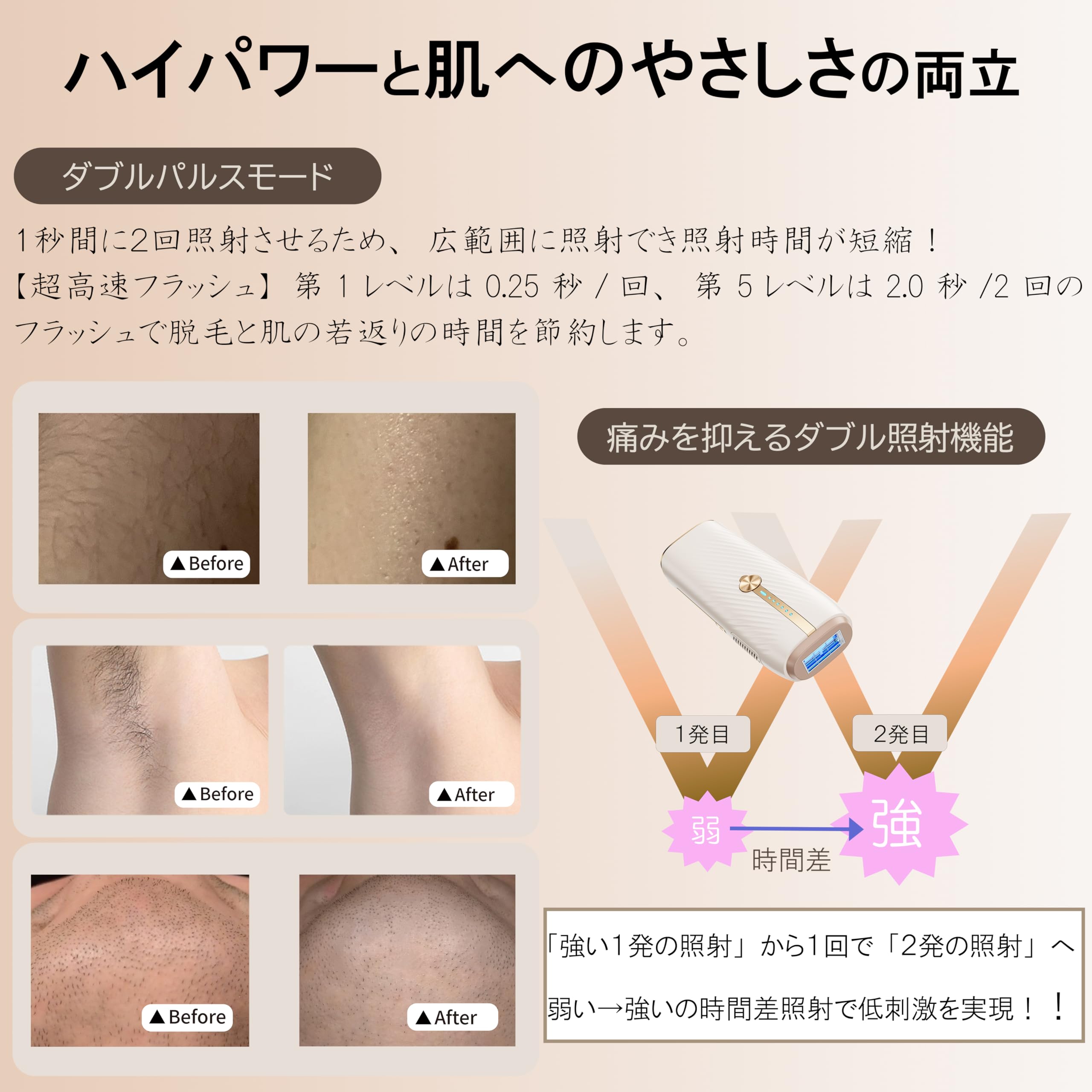 Amazon | ZENIX IPL光美容 ルピエ ハイパワー ハイスピード 連続照射