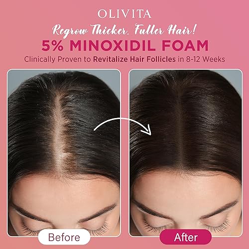 Miniatura 4 de Espuma de minoxidil al 5% para el crecimiento del cabello de las mujeres tratamiento de recrecimiento capilar extra fuerte, revitaliza los folículos
