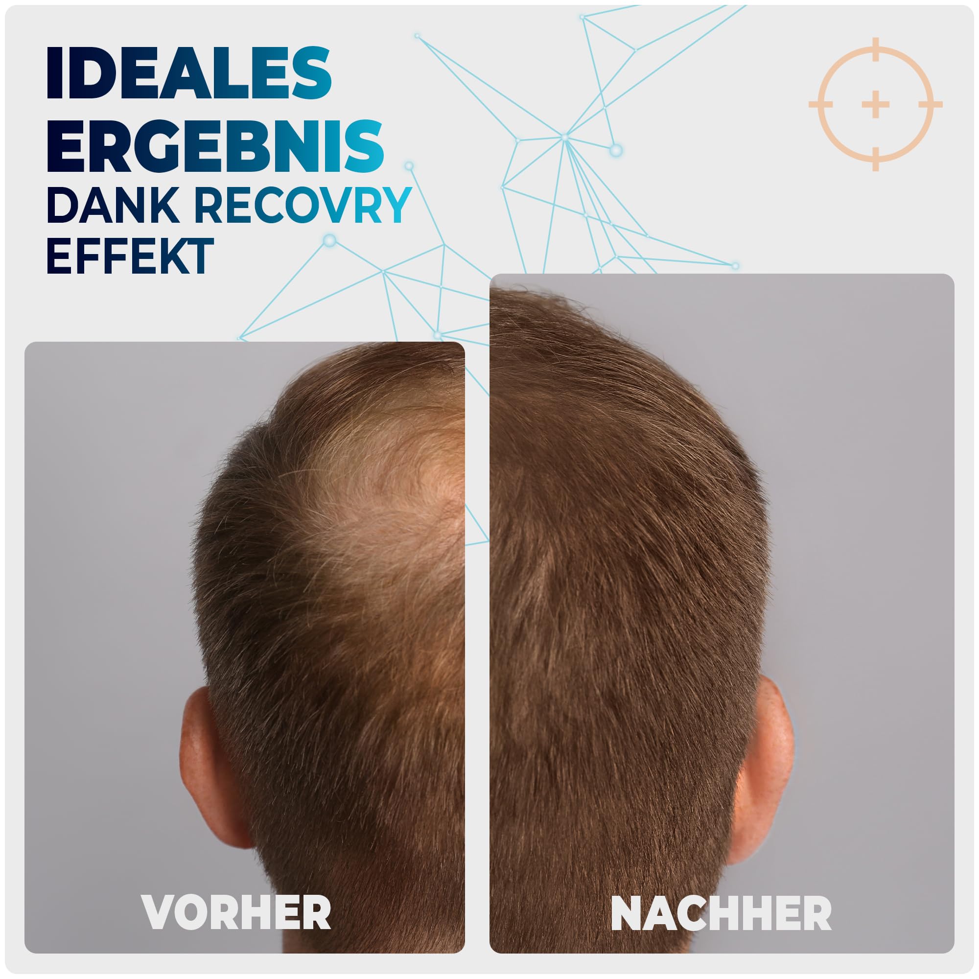 RecoVRY Dermaroller da uomo, 1 mm, 192 aghi veri per la massima crescita dei capelli, aghi in acciaio inox, promuove capelli densi e pieni | Micro Needle Roller (nero, Premium 1 mm)