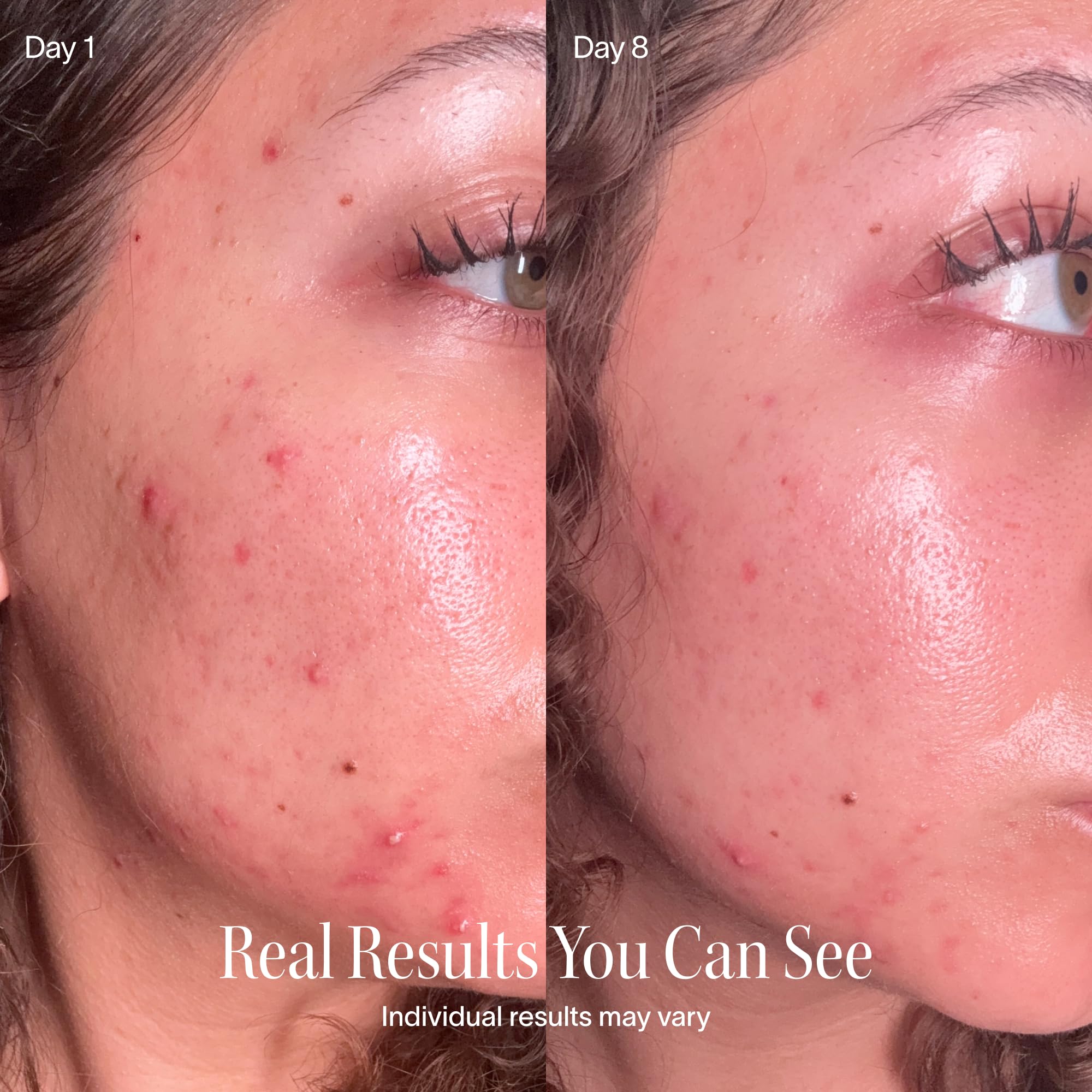 Solawave Bye Acne - FDA-Cleared Blue & Red Light Therapy for Face & Body | LED face wand helps reduce redness pimples zits & blemishes. Non-invasive painless 3-min use prevents future breakou product thumbnail 5