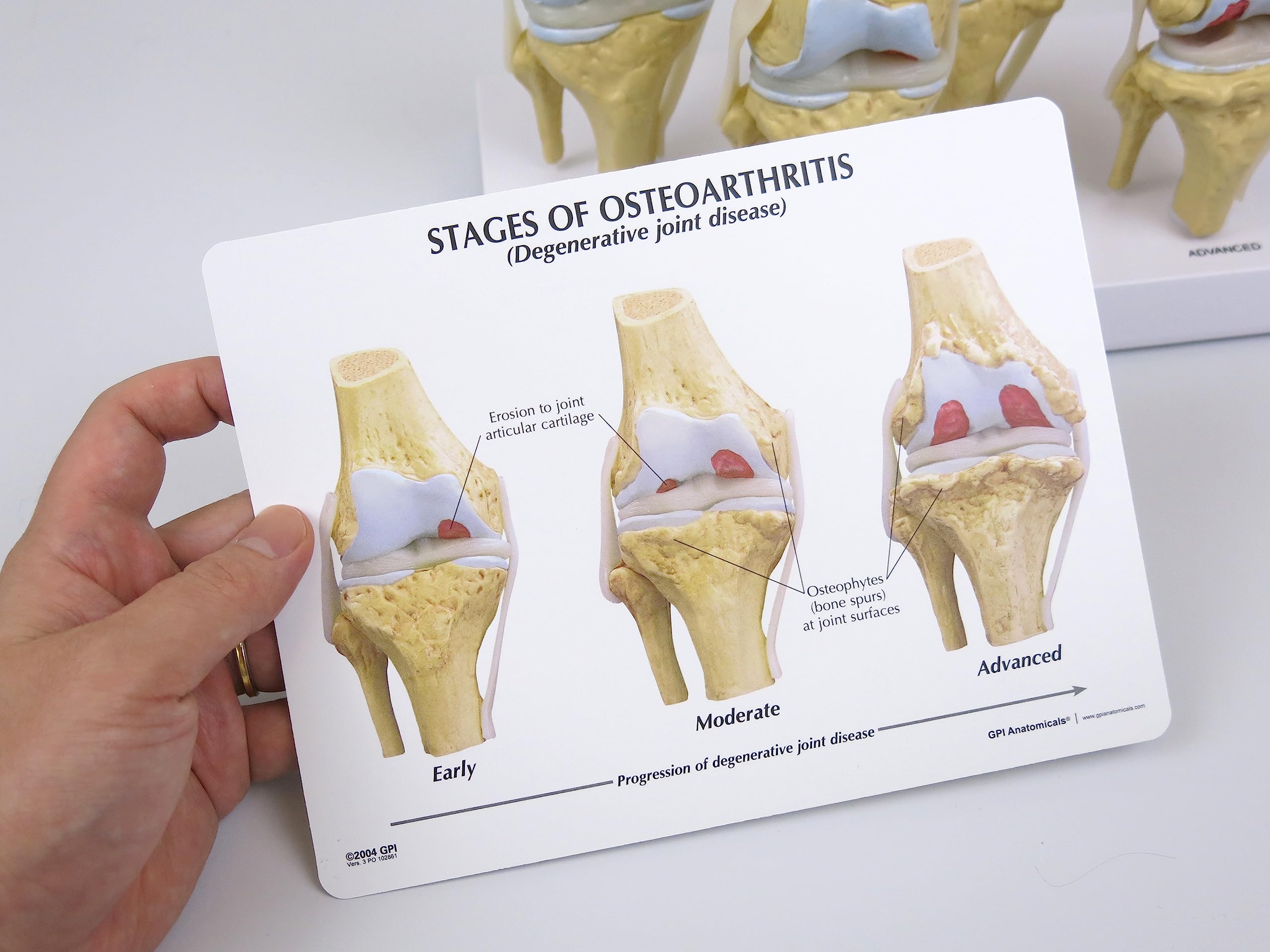 GPI Anatomicals 1100 Osteo-Kniemodellset 4 verschiedener Stadien
