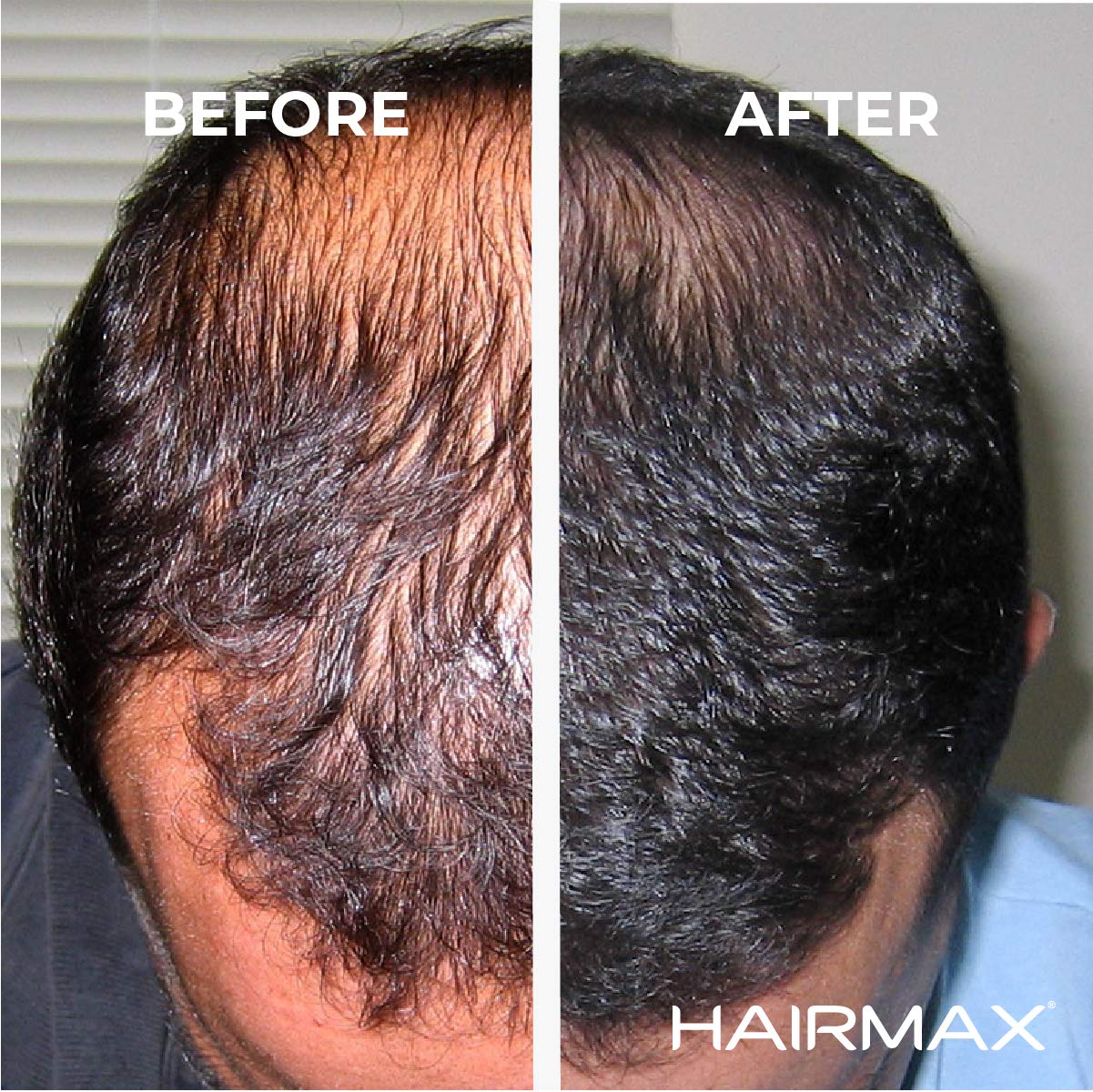 HairMax Hair Growth Laser Band LaserBand 41 (FDA Cleared), Hair Growth