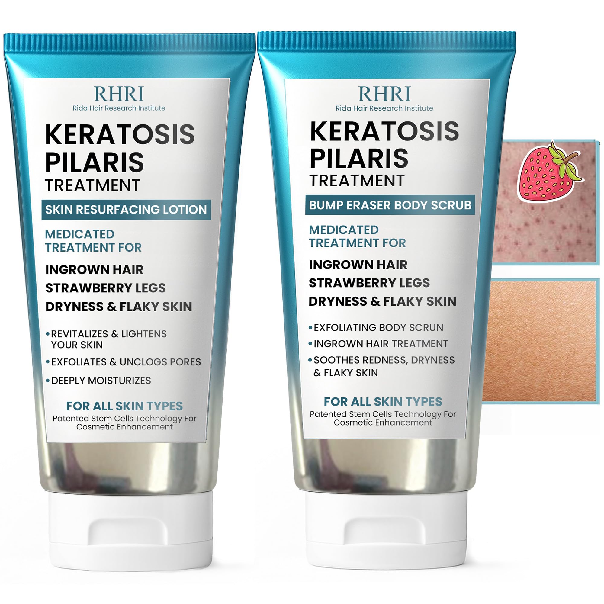 KP Bump Eraser Body Set | Keratosis Pilaris Treatment | Keratosis Pilaris Lotion | Exfoliating Body Scrub | Ingrown Hair Treatment | Bundle Set for Bump, Strawberry Legs, Redness, Dry & Flakey Skin