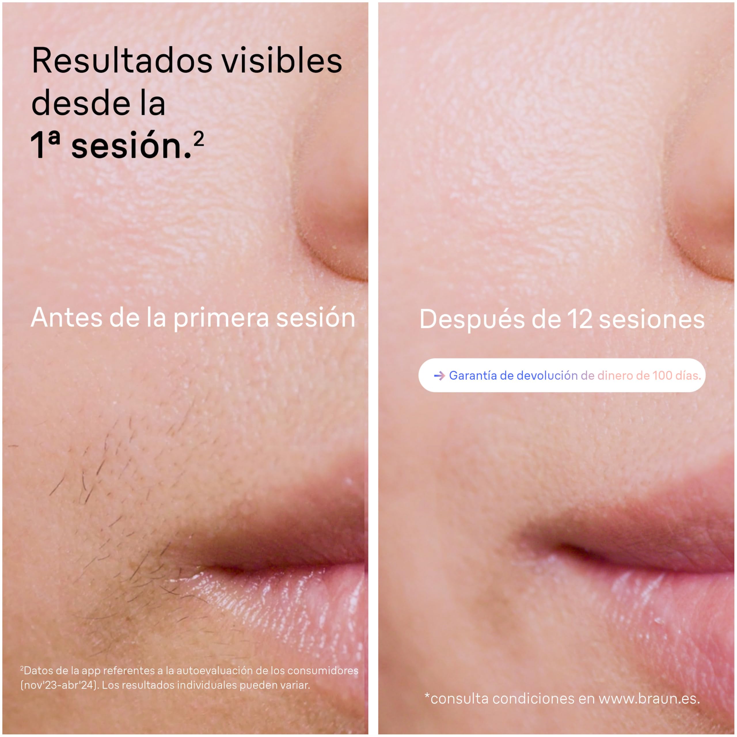 Braun Luz Pulsada Skin i·expert Smart IPL, PL7387, Blanco/Bronce - Alternativa a Depiladora Laser Con Inteligencia Artificial, Eliminación Del Vello En Casa, Neceser, Maquinilla Venus, 4 Cabezales