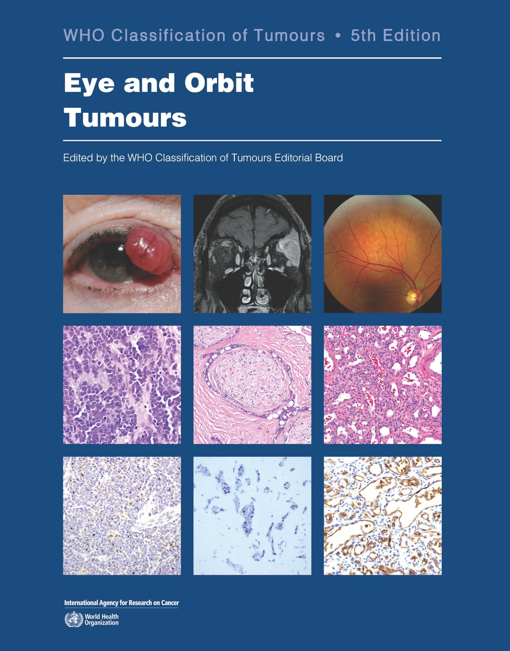 Amazon.com: WHO Classification of Tumours Editorial Board: books