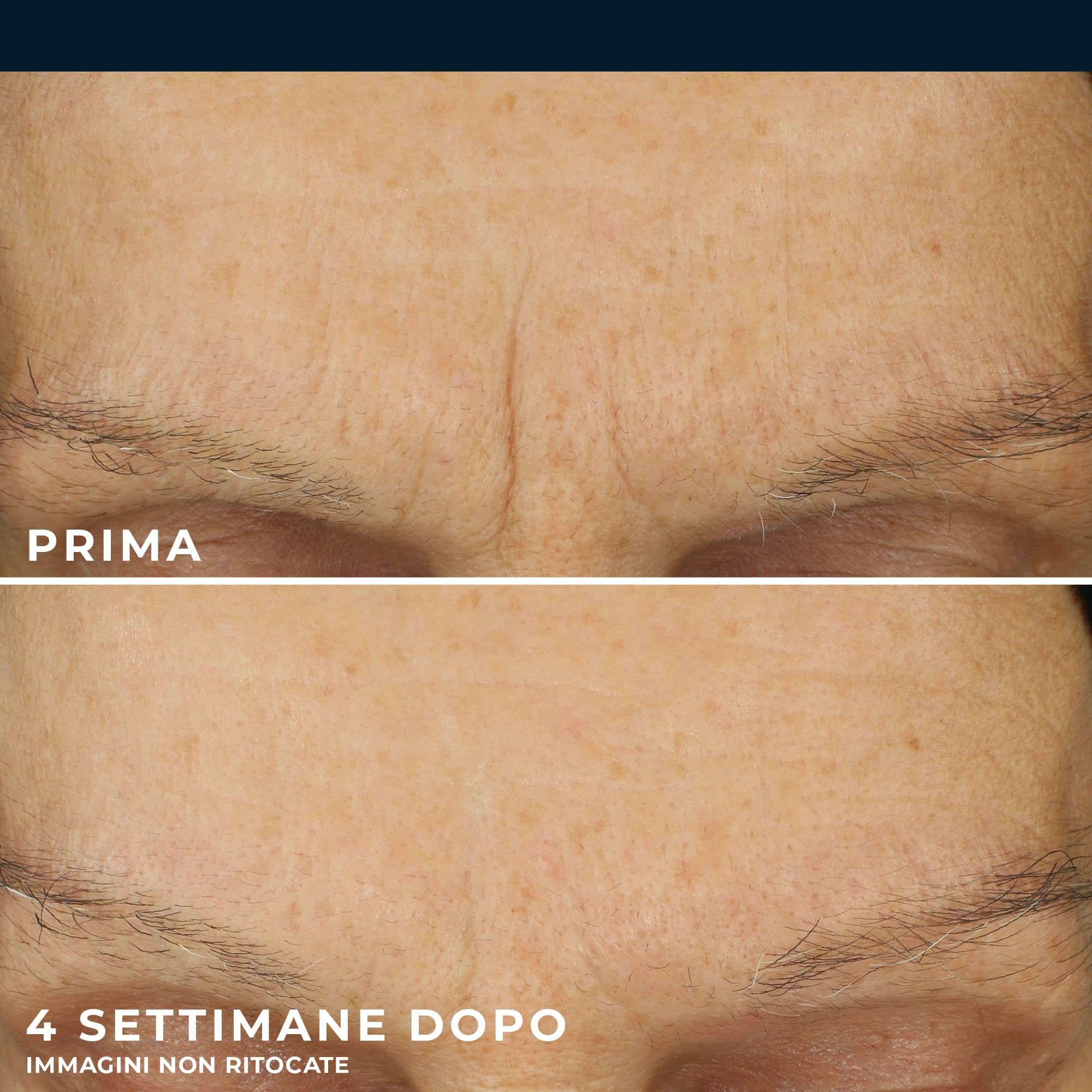 RoC - Retinol Correxion Line Smoothing Idratazione Massima - Trattamento Antirughe Intensivo - Pelle Più Liscia e Luminosa - Acido Ialuronico - 50 ml