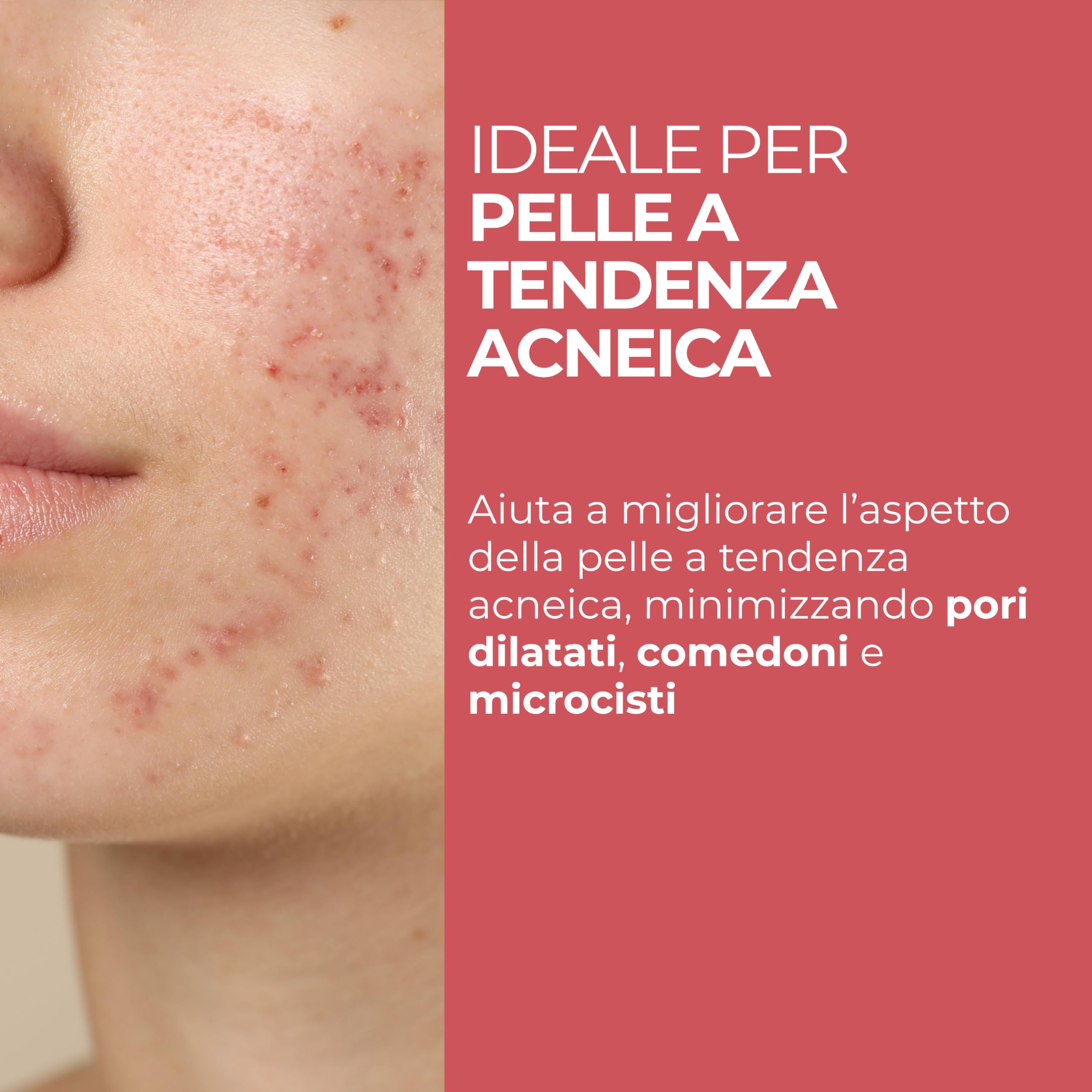 MOST - Glicosal Esfoliante Viso Micropeeling, Lozione con Acido Salicilico e Acido Glicolico - Delicata Azione Peeling Viso e Anti Macchie, Pelle a Tendenza Acneica, Impura, Melasma, Imperfezioni 50ml