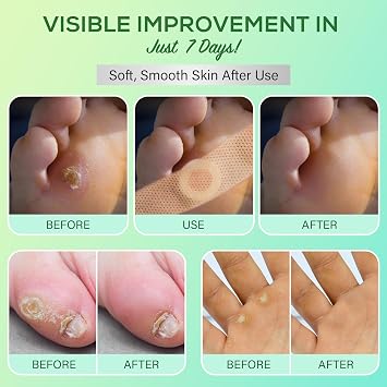 SupreH Corn Removers for Toes Feet Bandages: Corn Cushions and Small Callus Removal with 40% Salicylic Acid Long Adhesive - for Adult Seniors Nurses Hikers Athletes Men Women Pads 22 P