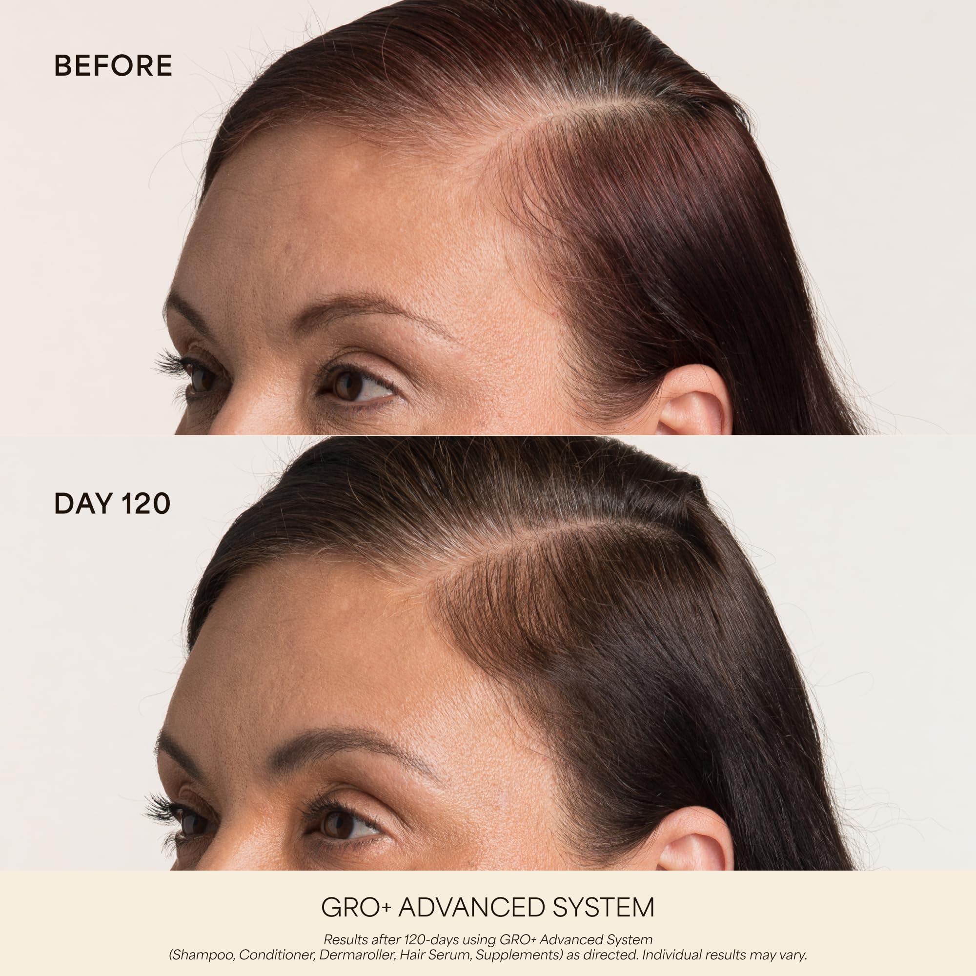 VEGAMOUR Scalp Dermaroller - MD-Developed, 1,200 Medical-Grade Needles, Enhances Serum Absorption, Twist-On Replaceable Head, Protective Case Included