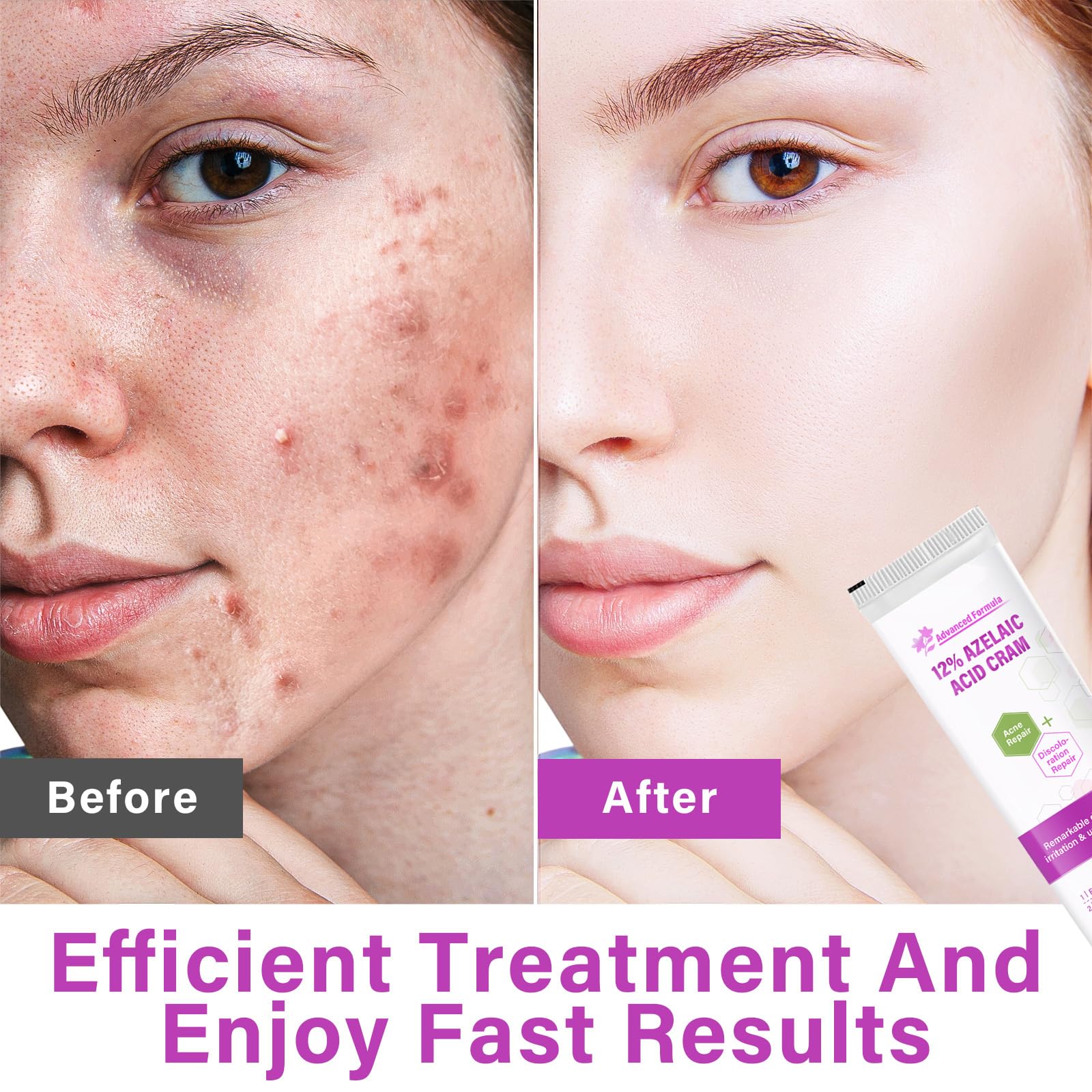 Siero Al 12% Di Acido Azelaico, Combatte Acne E Brufoli, Brufoli Invisibili, Libera I Pori, Riduce Significativamente L'Irritazione, Siero Antiacne Per La Pelle, 1 Oz