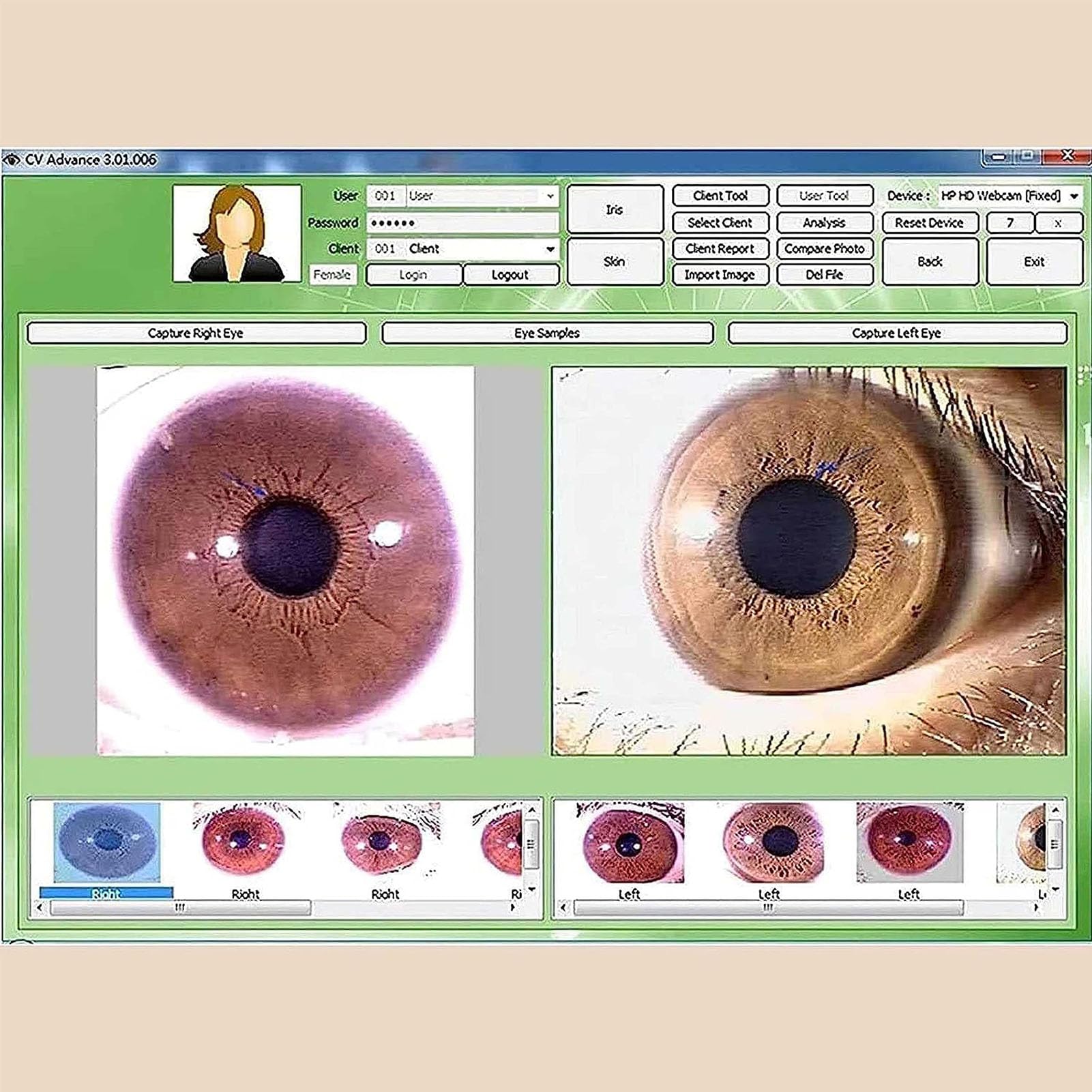 Telecamera di analisi dell'iride, Analizzatore Dell'iride Alternata con Obiettivo dell'iride HD 30X e Software di Analisi Senza Driver, Focus Regolabile ad Alta Risoluzione 2560 x 1920