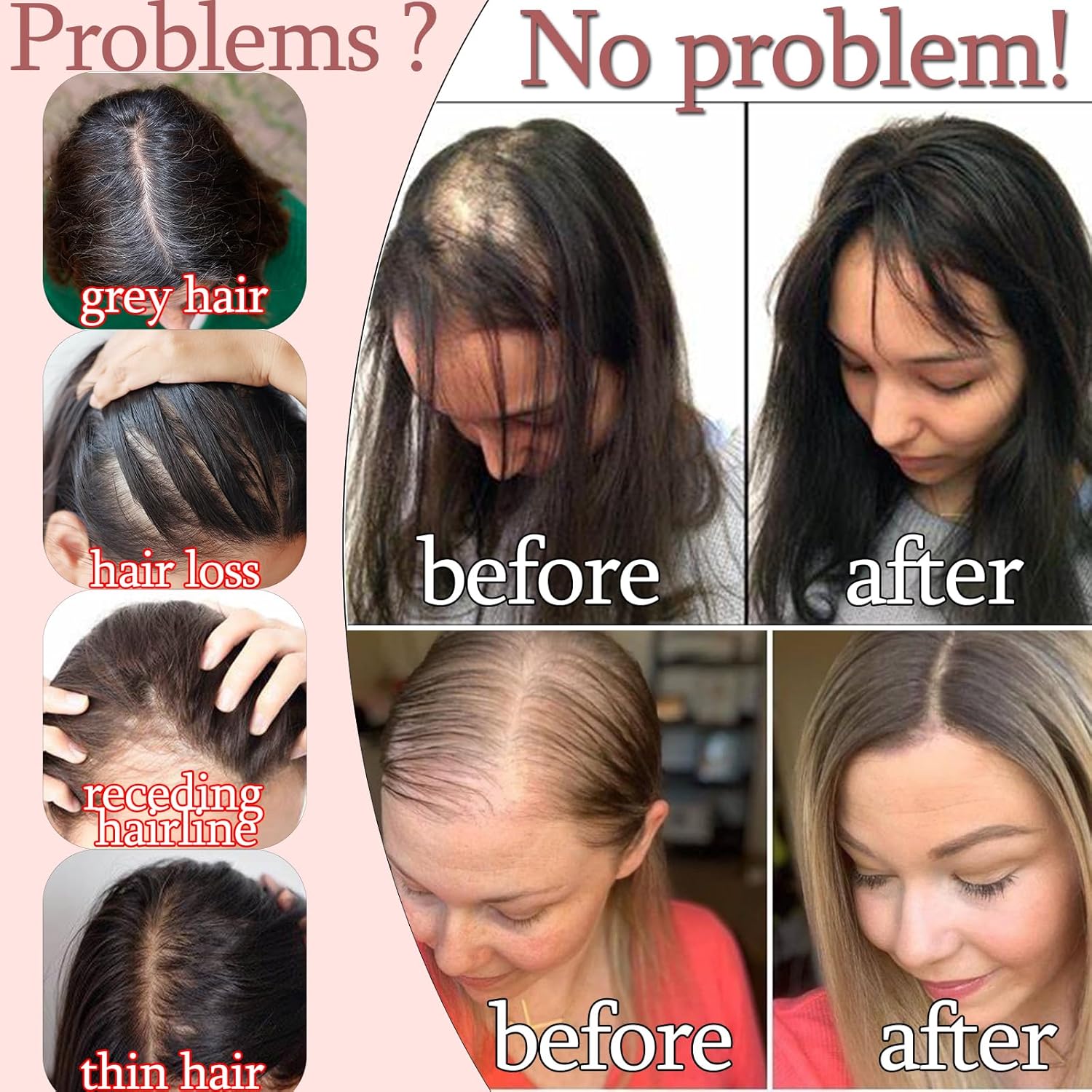 Human Hair Toppers for Women with Thinning, Real Toppers for Womens Real Human Hair for Hairloss Greyhair