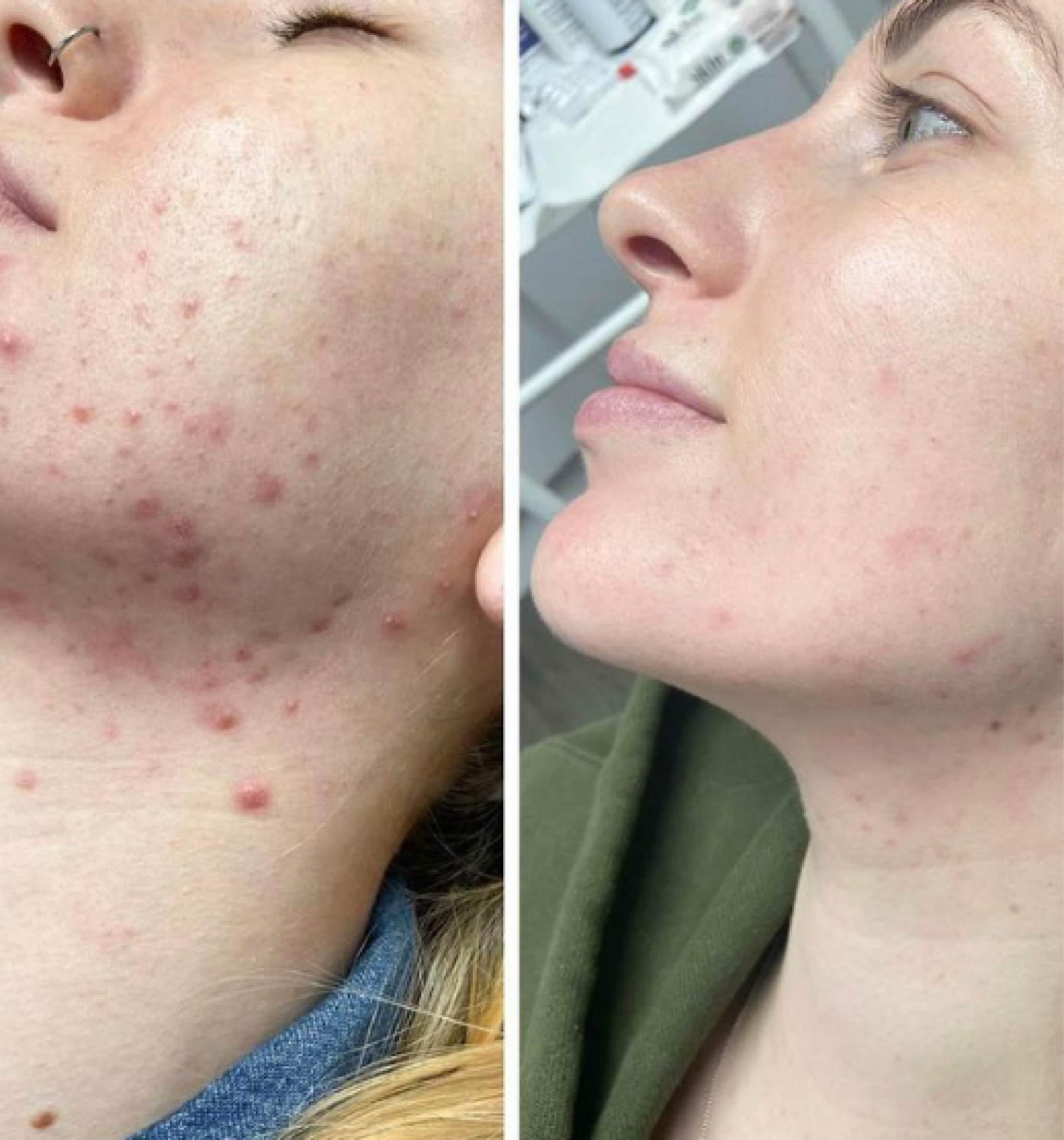 TCATherapyCare Solution Acid Peel 90% (Livello 2 pH 1.9) - Esfoliante, texture e tono della pelle - peeling viso - 30 ml con neutralizzatore (100 ml)