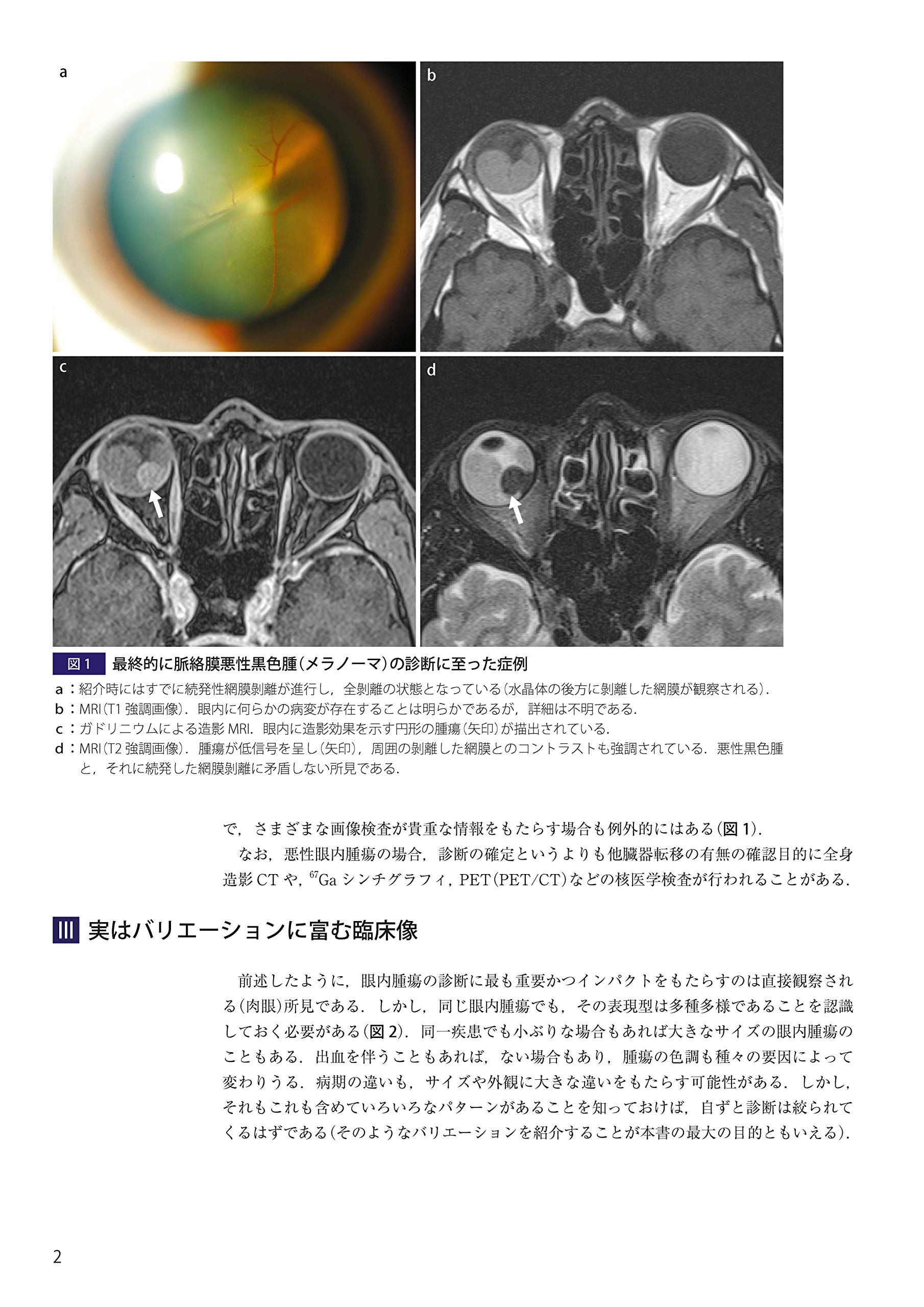 ☆セール 眼内腫瘍アトラス (新品) - 健康/医学