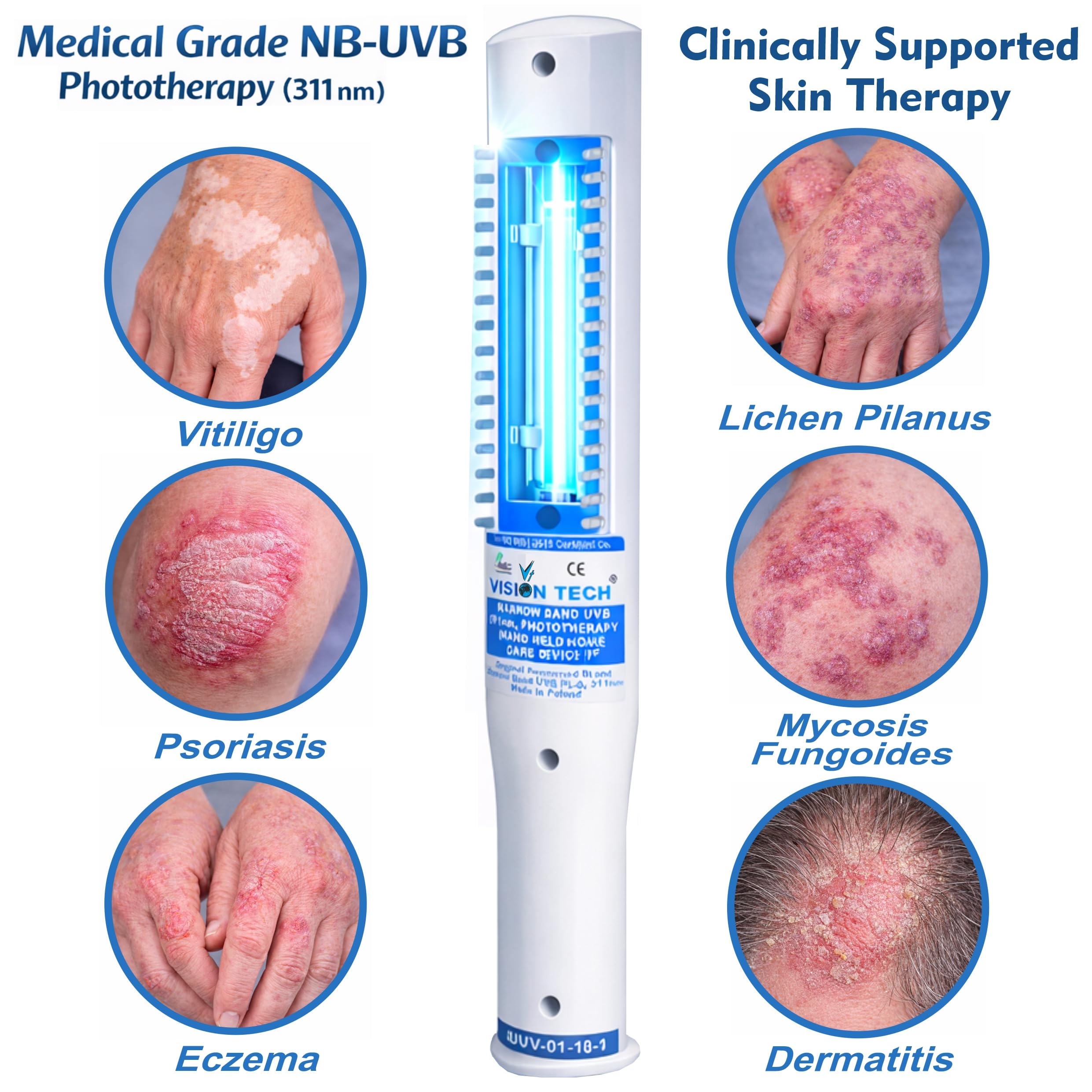 VISION TECH 311nm NBUVB Handheld Phototherapy for Vitiligo + Free eBook 4