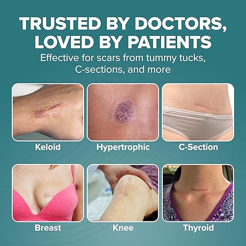 Miniatura 7 de Epiderm - Tiras de gel de silicona para el cuidado de cicatrices, sección C, cinta de abdominoplastia y cicatrices de cirugía cardíaca, tiras