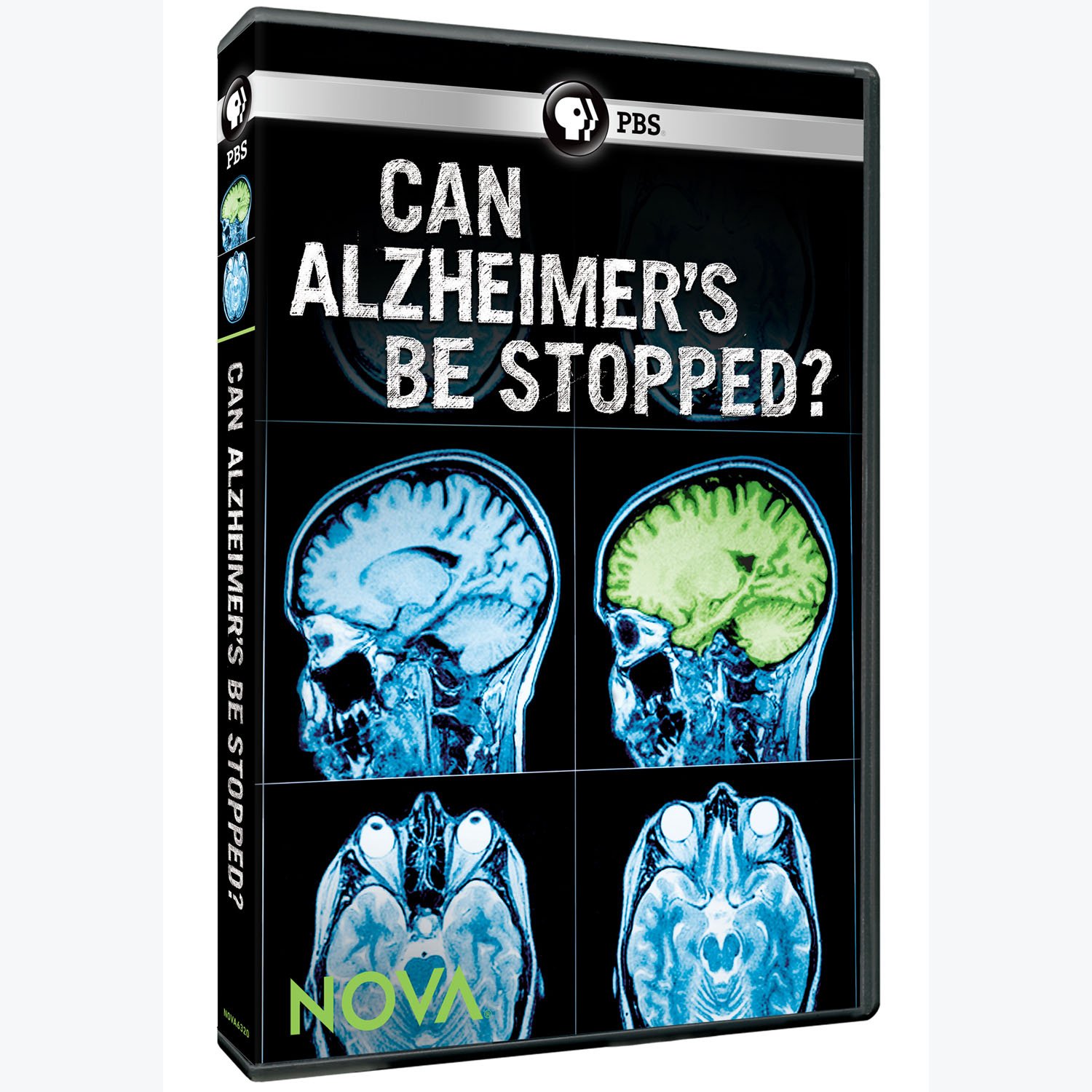 Nova Can Alzheimer'S Be Stopped DVD con análisis de ensayos clínicos e investigación médica