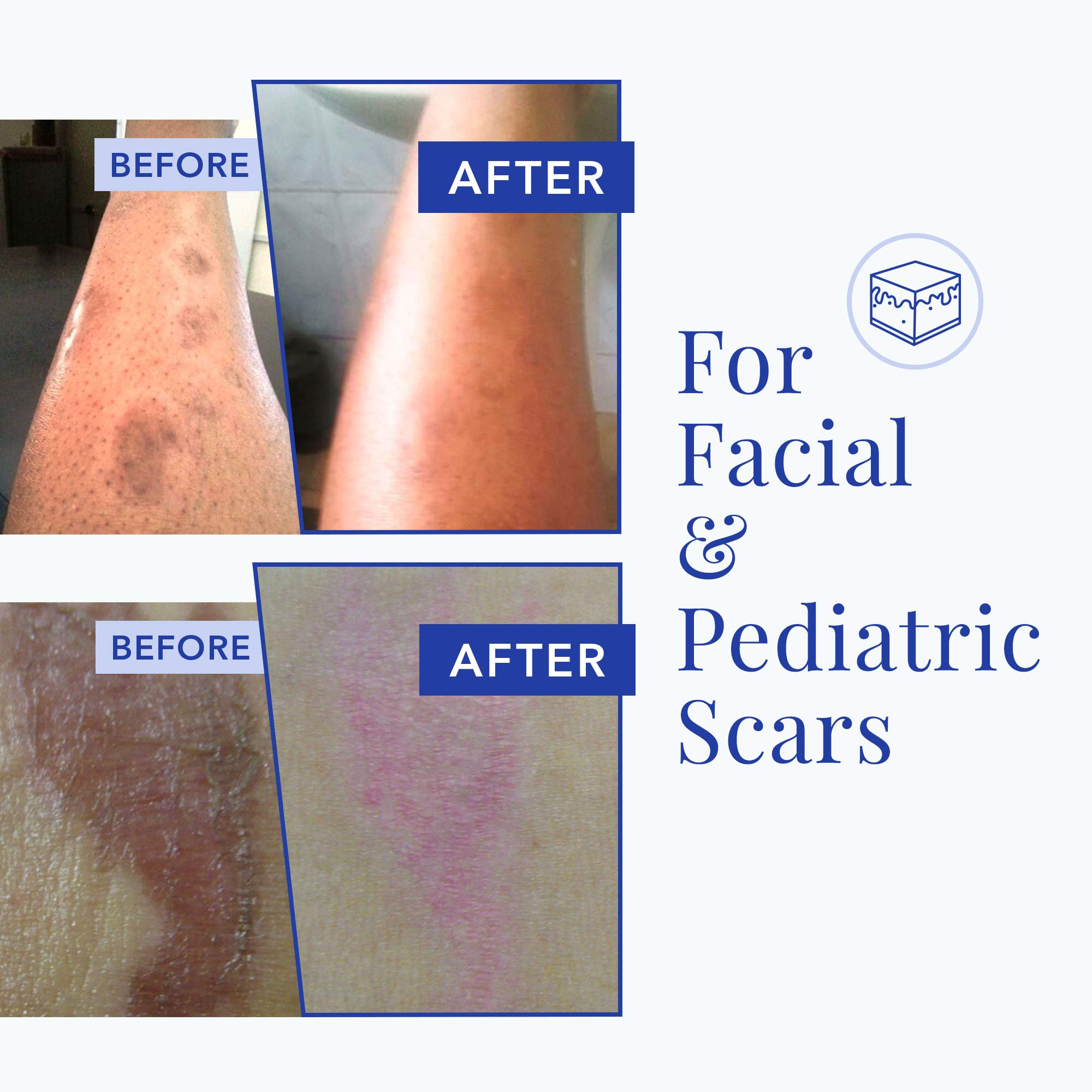 Scar Esthetique Scar Crème with Silicone, Scar Cream Treatment, 60mL