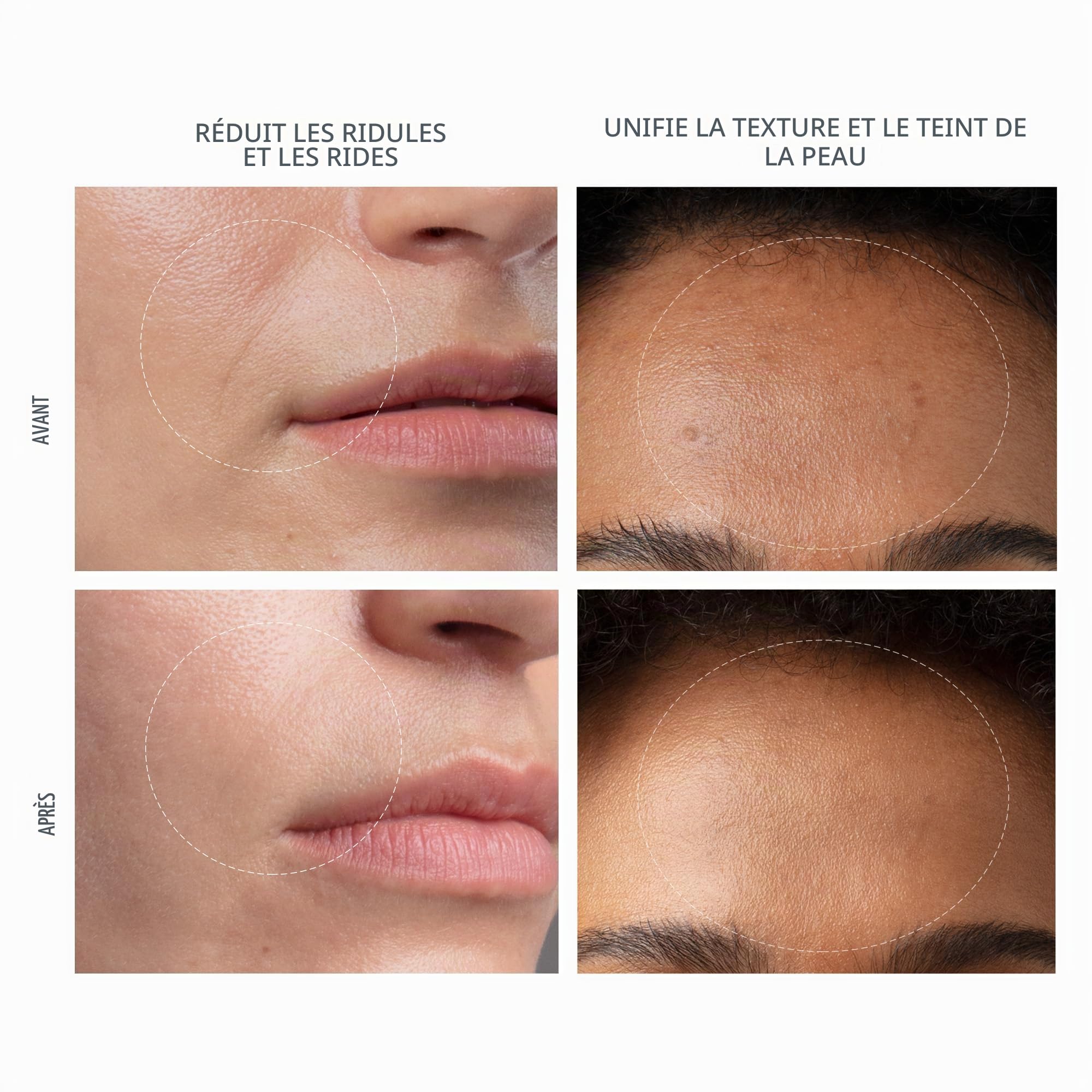 FOREO KIWI derma Appareil dermabrasion visage Extracteur point noir - Skincare - Aspirateur point noir - Extraction sans bandelettes - Tire comédon point noir sous vide