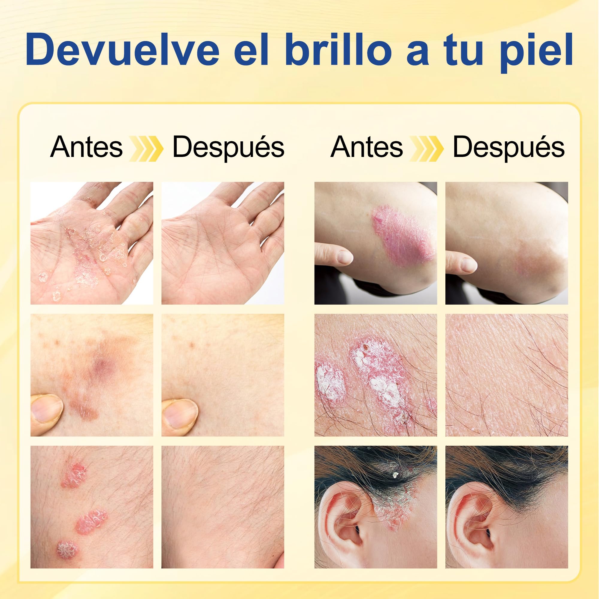 Crema para la Psoriasis,Crema Antipruriginosa 20g,Alivio del Picor y la Descamación,Cuidado Corporal para Pieles Muy Secas y Sensibles - 5