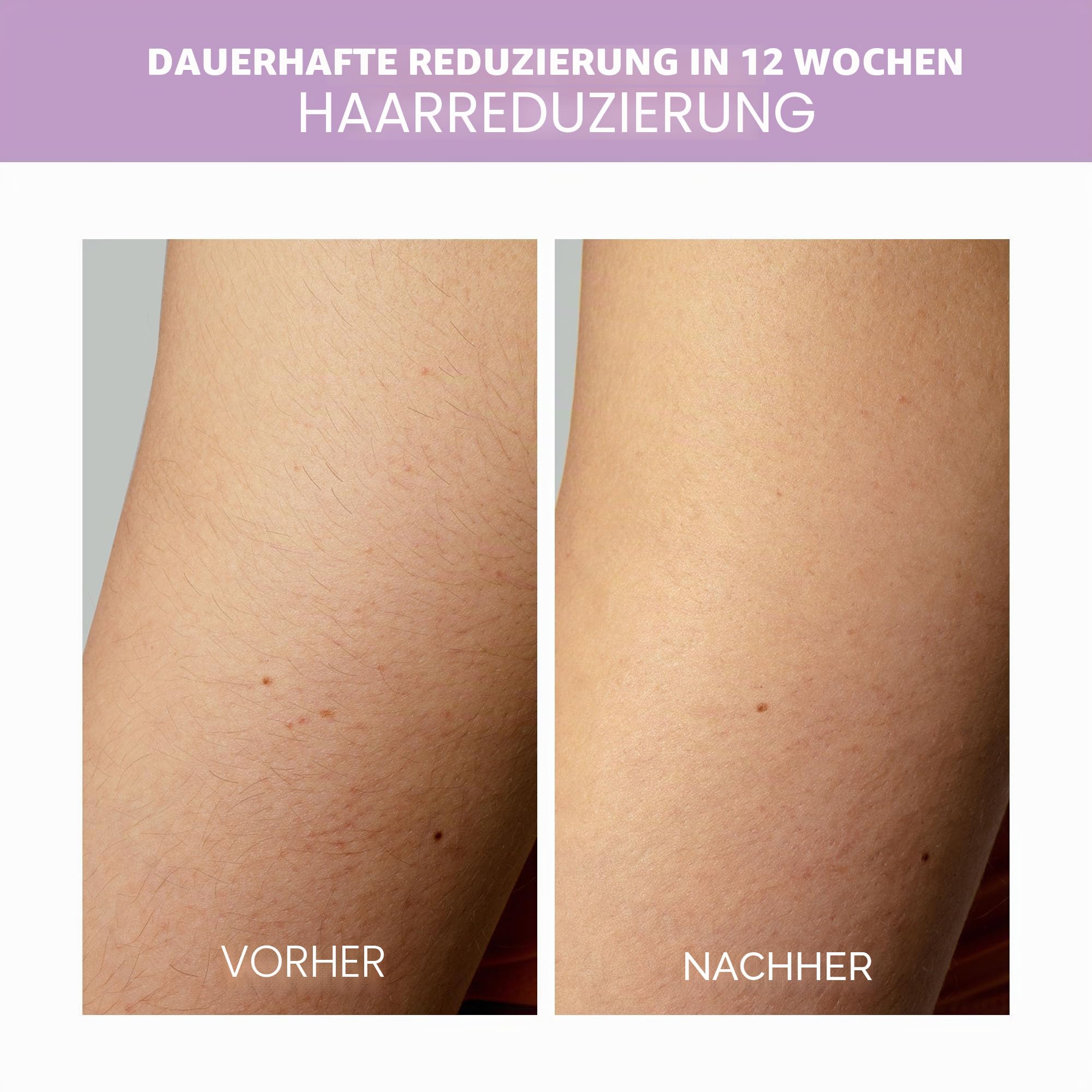 FOREO Fuzz-free Peach 2 go Set Epilierer mit pulsiertem Licht permanente Haarentfernung Gesicht Körper