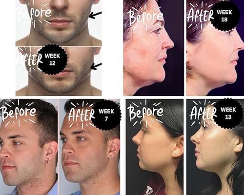 Miniatura 7 de Goma de mascar GUMBELLS 12XHard JAWLINE & FACIAL FITNESS xilitol (paquete de 1 mes) Mejora, define y fortalece tu mandíbula y boca facial estilo