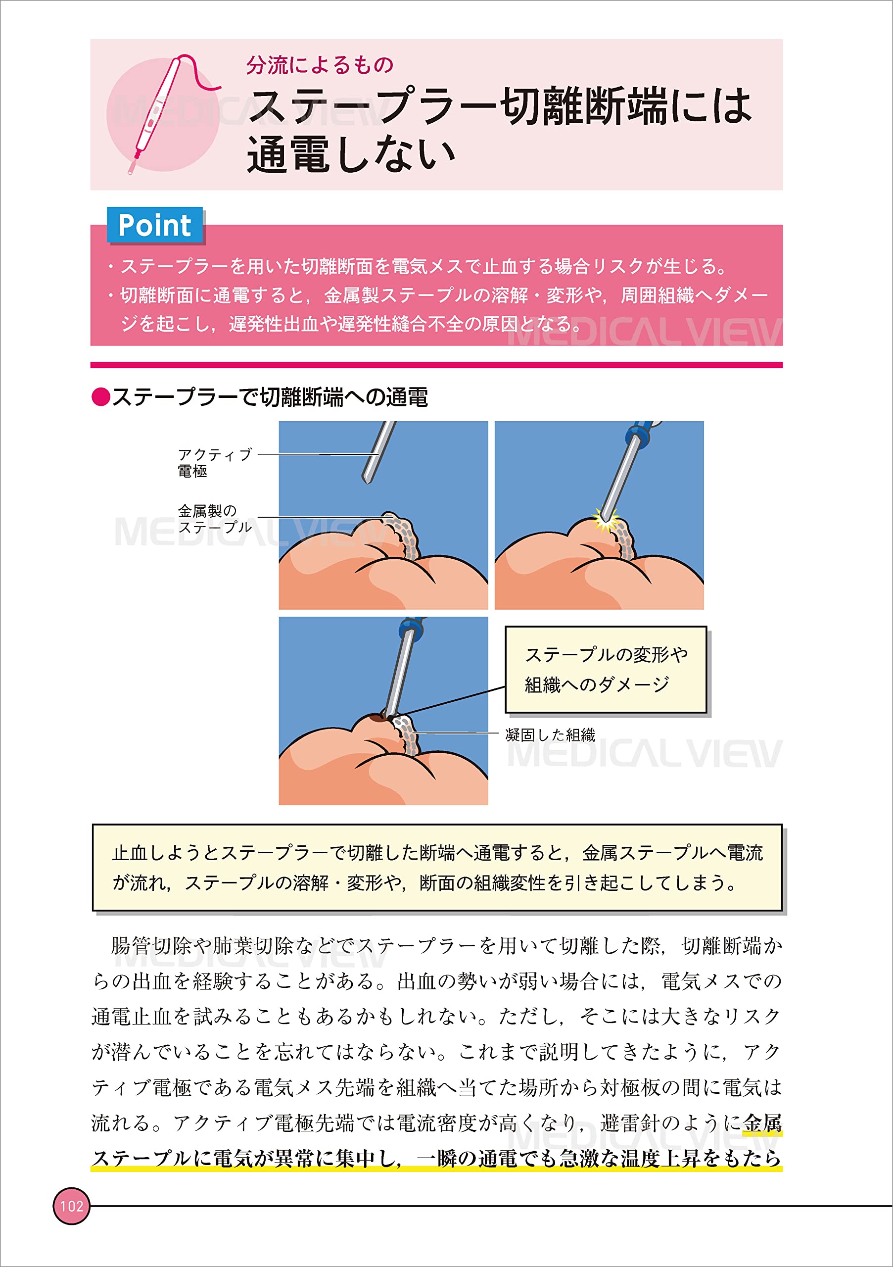 Fuse資格者が教える 電気メス 使いこなすための原理と意外と知らないリスク 使い方がわかる動画付 渡邊 祐介 本 通販 Amazon
