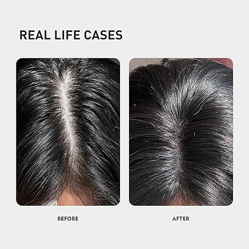 Miniatura 3 de KINTOR 0.5% KX-826 Spray para el crecimiento del cabello DHT bloqueador Productos de recrecimiento del cabello, nutre los folículos pilosos,