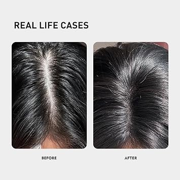 KINTOR 0.5% KX-826 Hair Growth Spray DHT Blocker Hair Regrowth Products,Nourish Hair follicles,Hair Oil Control Products For Men&Women-1 Month Supply 60ml