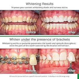 Opalescence Go 10% - Prefilled Teeth Whitening Trays Kit (10 Treatments) - 10% Hydrogen Peroxide - Mint Made by Ultradent Products. Go Teeth Whitening Kit -Mint- GO10-5193-1