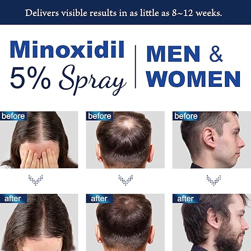 Miniatura 3 de 5% de minoxidil para hombres y mujeres en aerosol para el crecimiento del cabello (6.1 fl oz)