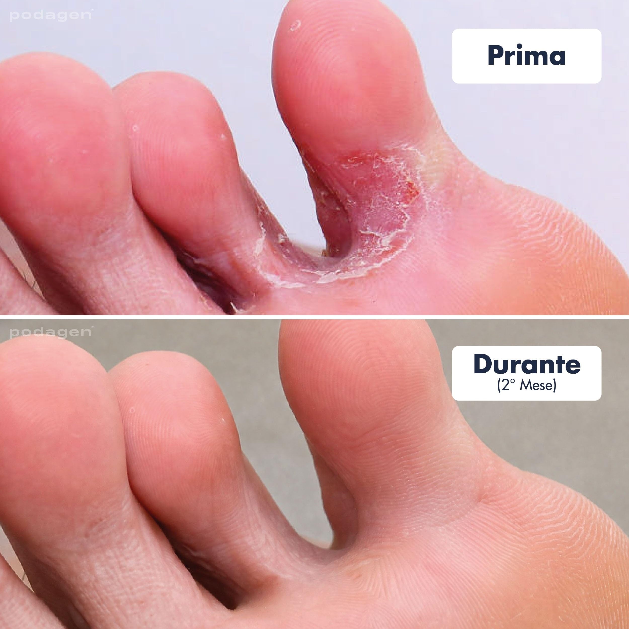 podagen piedi, 2/4/8 Pezzi Penna Cura Piedi Donna con Pennello Integrato Cura Unghie Piedi Formula ad Asciugatura Rapida Applicazione Precisa Portatile per Uso Quotidiano