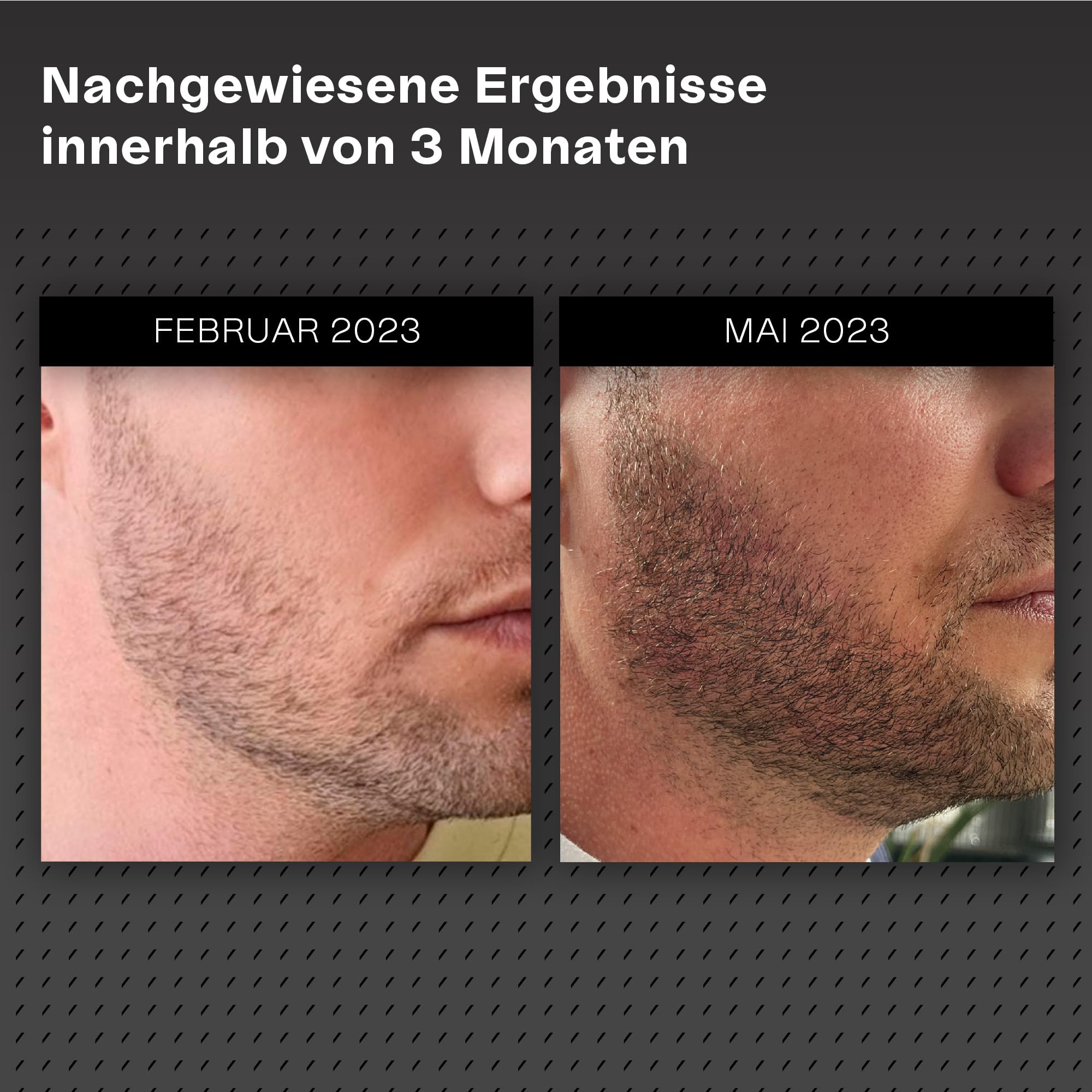Bartwachstums-Kit – Fördert das Wachstum von Bart & Schnurrbart – Derma-Roller-Griff mit 0,55 mm Roller-Kopf (Größe M), Serum 06 & Cleansing Spray – Für dünnes Gesichtshaar – Unisex