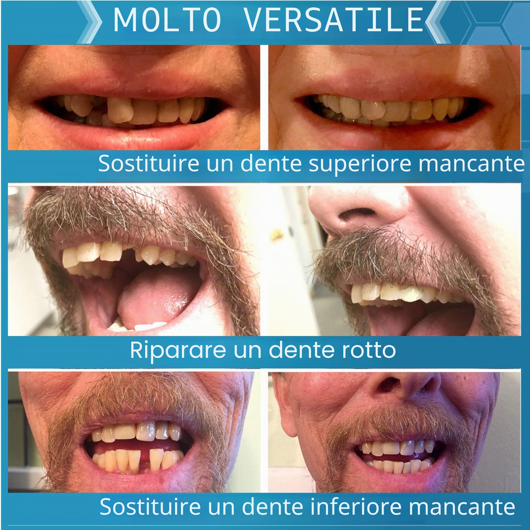 Instant Smile Completa il Tuo Sorriso Temporary Dental Replacement Kit, Easy Fit, One Size