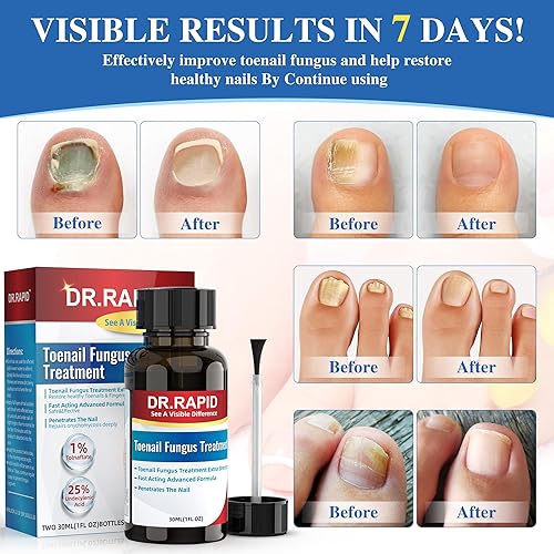 Miniatura 2 de Tratamiento de hongos en las uñas de los pies extra fuerte  Solución eficaz de reparación de uñas antifúngica con aceite de árbol de té para uñas de