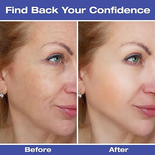 Miniatura 4 de Paquete de 2 parches antiarrugas para la frente, parches de arrugas para la cara durante la noche, 160 unidades de cinta facial para arrugas, tiras