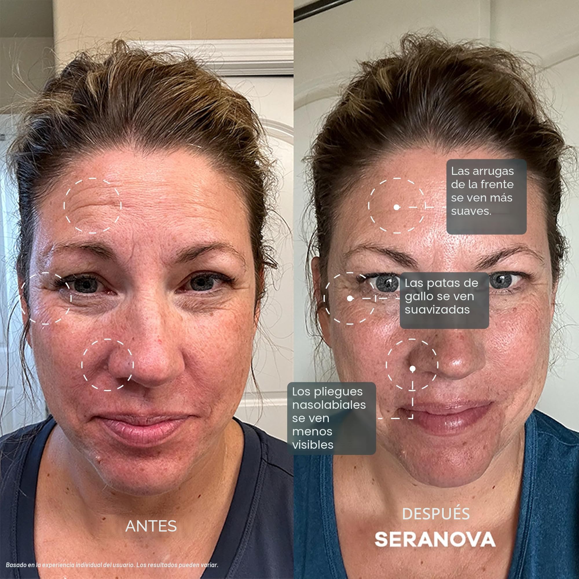Amazon.com: Seranova Sistema de Micro Infusión para Cara y Cuello