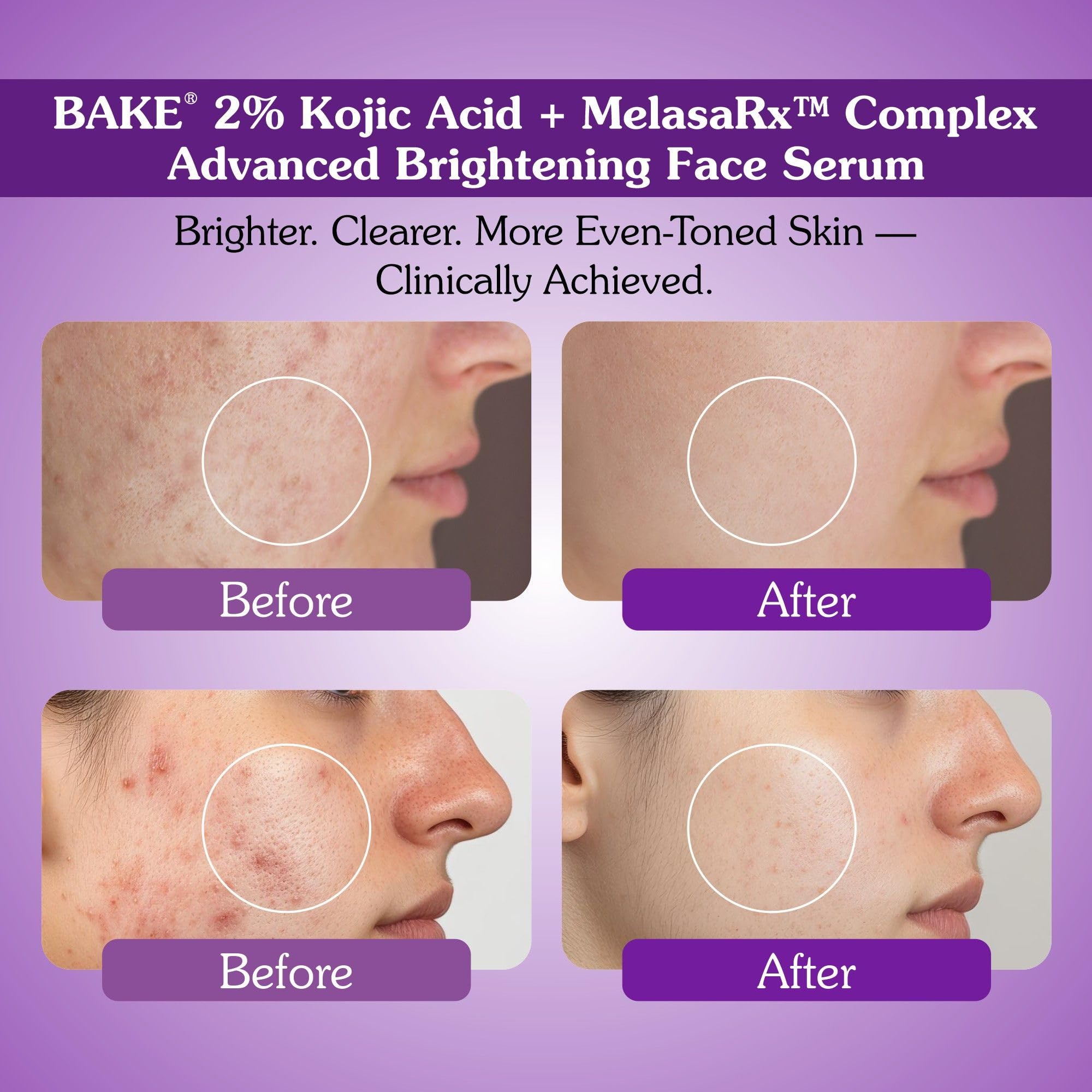BAKE 2% Kojic Acid Face Serum with MelasRx Complex, Alpha Arbutin & Niacinamide for Dark Spots, Pigmentation & Brightening Glow Skin| For Tan Removal & Sun Damaged Skin | Brightening Glow | 30ml 2