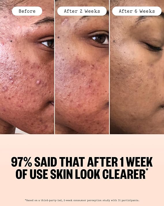 PEACE OUT Acne Face Serum with 2% Salicylic Acid (1 fl oz)