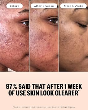 PEACE OUT Acne Face Serum with 2% Salicylic Acid (1 fl oz)