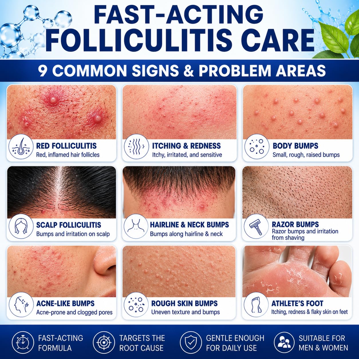 Folliculitis Treatment Cream, 5% Benzoyl Peroxide with Centella & Ceramides