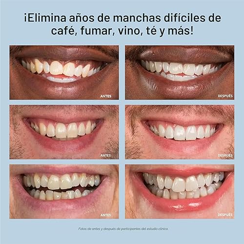 Miniatura 7 de Kit blanqueador de dientes, luz de LED, peróxido de carbamida del 35 %, (2) jeringuillas del gel 0.17 onzas líquidas, bandeja