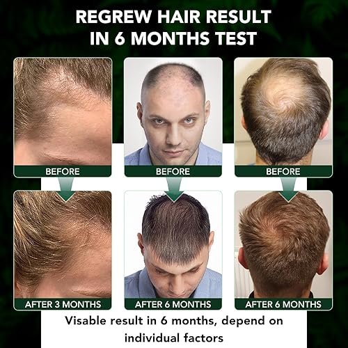 Miniatura 3 de Minoxidil para hombres y mujeres, aerosol para el crecimiento del cabello, 5% de aceite de crecimiento de barba de minoxidil, suero avanzado para el