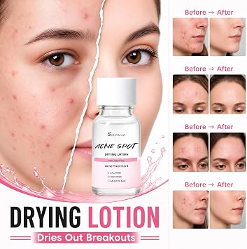 Premium Acne Spot Drying Lotion Kit with Swab, Overnight Acne Treatment For Face, Dry Out Pimples, Blemishes, Zits And Clean Pores, 12ml / 0.41 FlOz