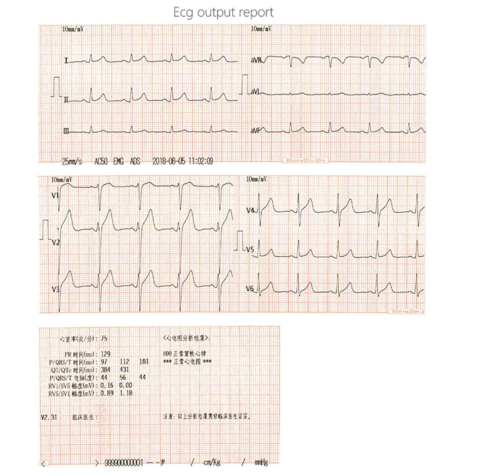 Elettrocardiografo Portatile, Monitor ECG A 12 Derivazioni E 3 Canali Con Analisi Automatica, Funzione Di Stampa Dei Referti, Display Lcd A Colori, Dispositivo Diagnostico Per Uso Domestico