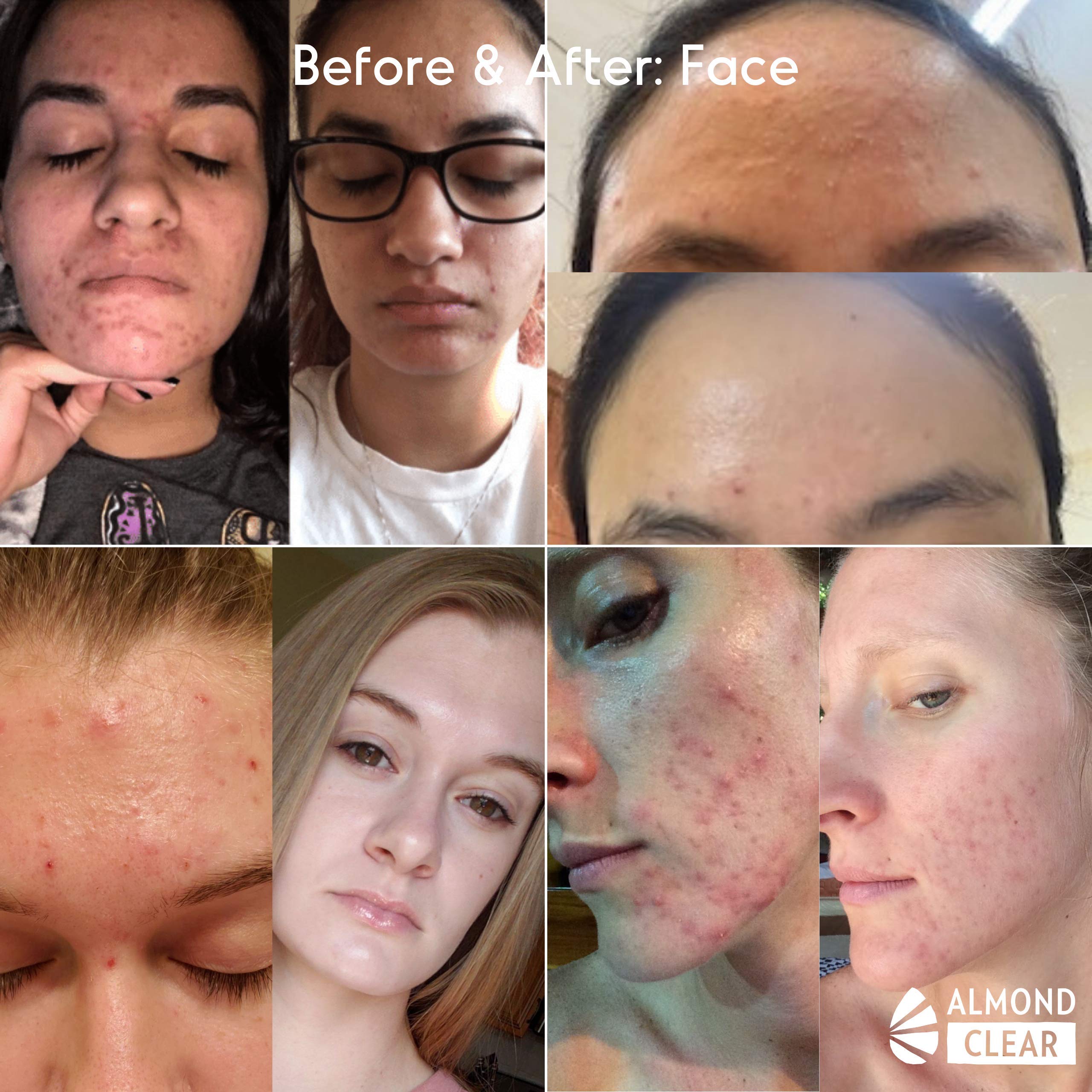 Face & Body Clearing Serum, Level 1 for acne, folliculitis, aging skin