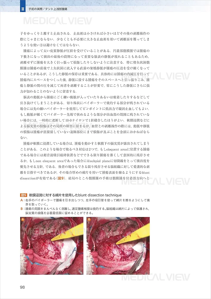 脳腫瘍外科経験したい手術16 スタンダードからアドバンス 脳腫瘍外科 経験したい手術16−スタンダードからアドバンス